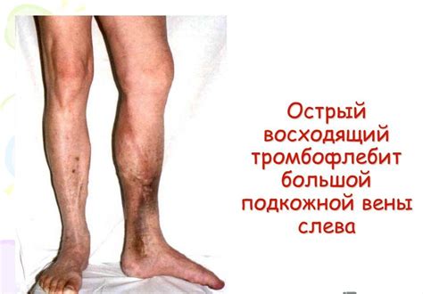 лечение на разширени вени на долните крайници Казан